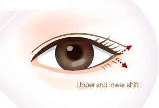 Tạo dáng to tròn cho đôi mắt gần nhau bằng phẫu thuật mở rộng đuôi mắt 6