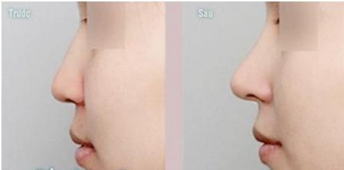  Nâng mũi silicone, sụn & tiêm - Đâu là phương pháp hoàn hảo nhất 11