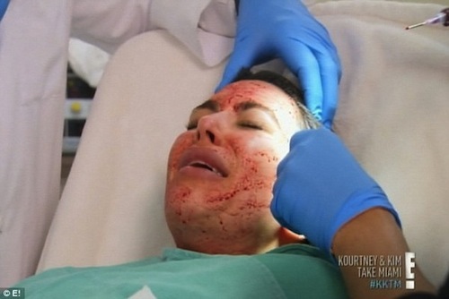 Kim Kardashian chăm sóc da mặt bằng... máu người  2