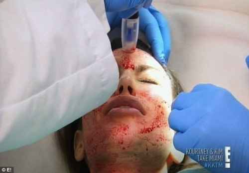Kim Kardashian chăm sóc da mặt bằng... máu người  4