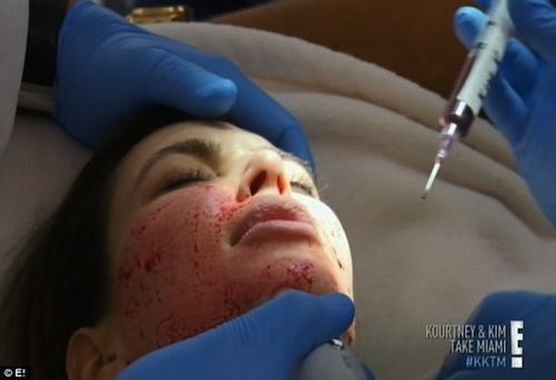Kim Kardashian chăm sóc da mặt bằng... máu người  5