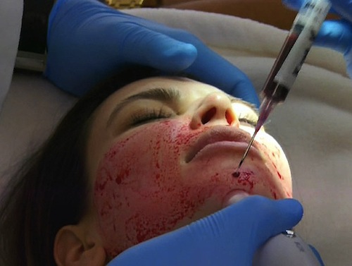Kim Kardashian chăm sóc da mặt bằng... máu người  7