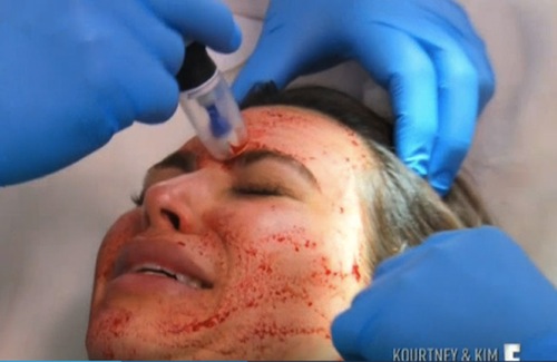 Kim Kardashian chăm sóc da mặt bằng... máu người  8
