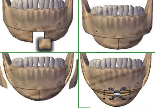 PTTM gọt hàm: Phức tạp và đau đớn 4