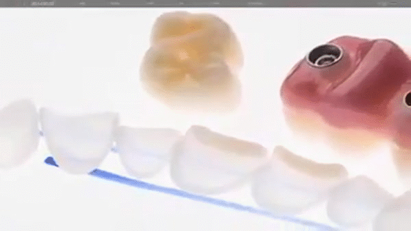 bọc răng sứ 