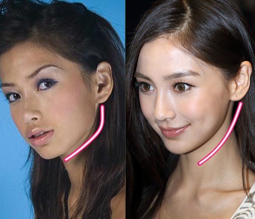 Angelababy phẫu thuật thẩm mỹ 