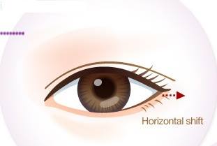 Cận cảnh phương pháp kích mắt to bằng phẫu thuật khóe & đuôi mắt 10