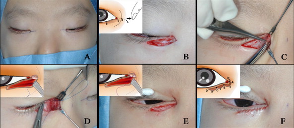 Cận cảnh phương pháp kích mắt to bằng phẫu thuật khóe & đuôi mắt 4