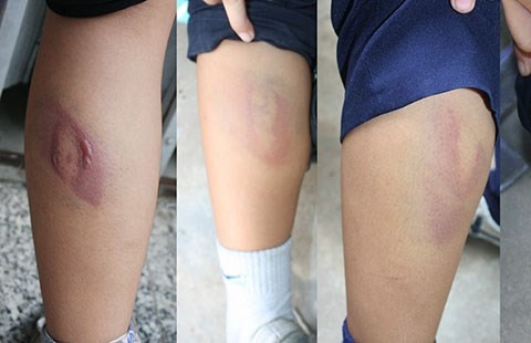  Cô giáo đánh bốn học sinh bầm tím chân 1