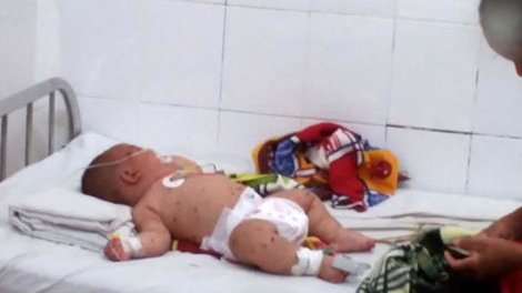 Bé trai 5 tháng tuổi nghi bị nhiễm Não mô cầu đầu tiên ở Đắk Lắk 