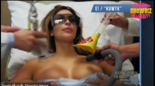 Kim Kardashian chữa rạn ngực bằng tia laser   1