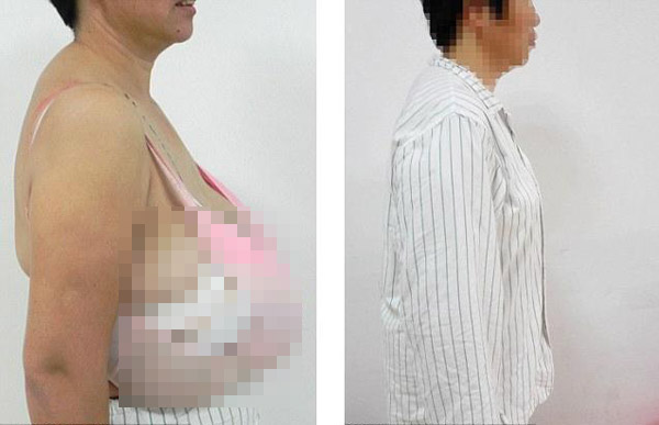 Phẫu thuật cắt bỏ 6kg mô ngực vì vòng 1 quá khổ 2