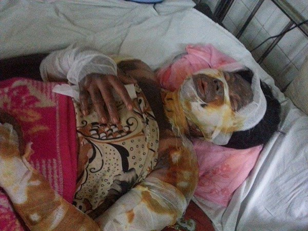 Thai nhi 3 tháng tuổi đang sống trong cơ thể bị thiêu đốt của người mẹ 1