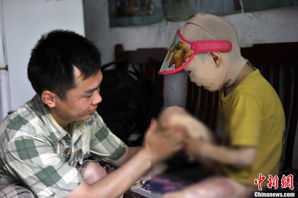 Cuộc sống đ&aacute;ng thương của c&ocirc; b&eacute; 6 tuổi bị bỏng to&agrave;n th&acirc;n 7
