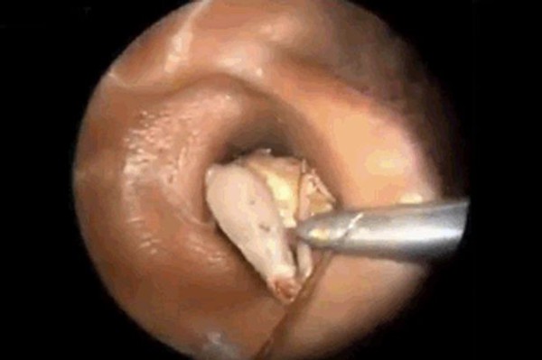 Video gắp côn trùng to bằng ngón tay khỏi tai gây sốc Video gắp côn trùng to bằng ngón tay khỏi tai gây sốc
