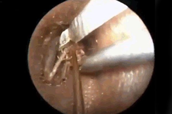 Video gắp côn trùng to bằng ngón tay khỏi tai gây sốc