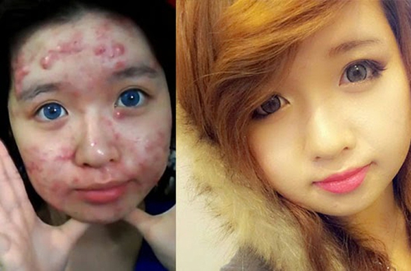 trang điểm che mụn trang điểm che mụn