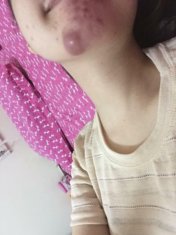 hậu quả tiêm chất làm đầy hậu quả tiêm chất làm đầy