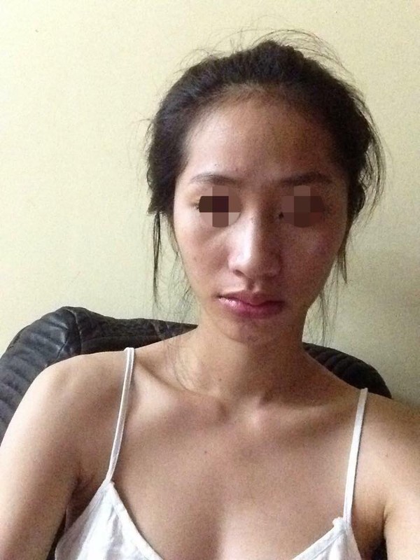 hậu quả tiêm thẩm mỹ hậu quả tiêm thẩm mỹ