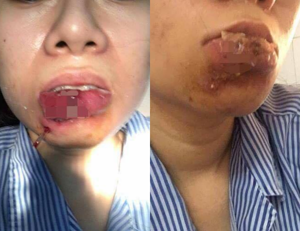 hậu quả tiêm thẩm mỹ hậu quả tiêm thẩm mỹ