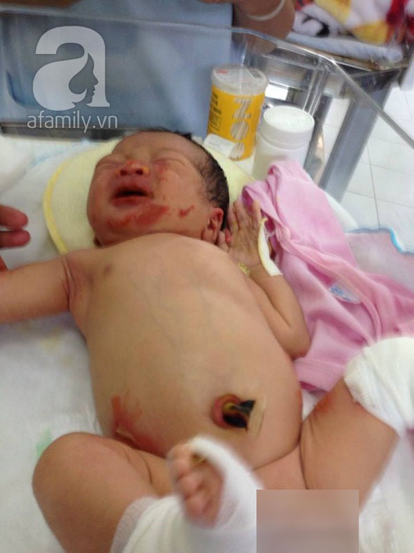 Em bé sơ sinh bị bỏ rơi có hai vết thương ở chân rất nặng 1