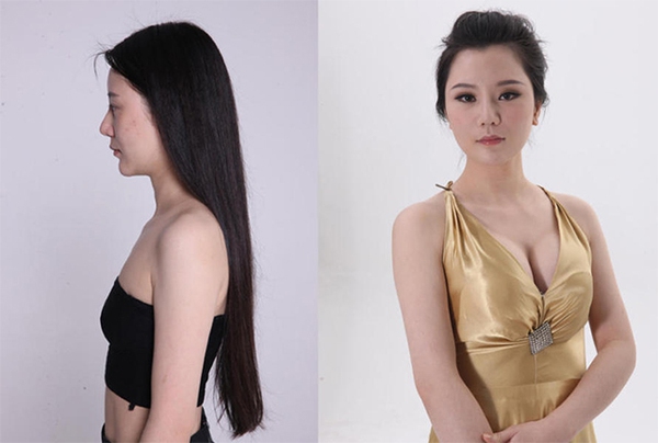 Loạt ảnh trước và sau phẫu thuật thẩm mỹ của 20 phụ nữ Trung Quốc gây sốc 11