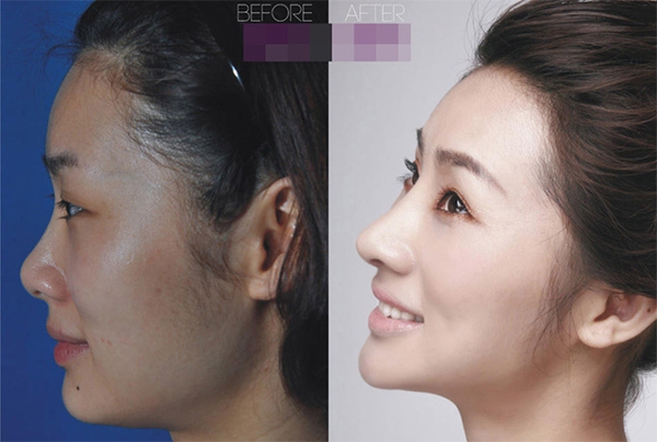 Loạt ảnh trước và sau phẫu thuật thẩm mỹ của 20 phụ nữ Trung Quốc gây sốc 12