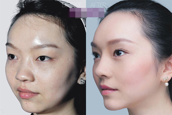 Loạt ảnh trước và sau phẫu thuật thẩm mỹ của 20 phụ nữ Trung Quốc gây sốc 14
