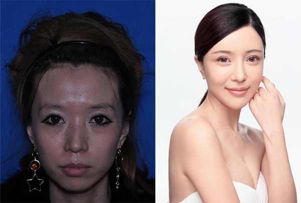 Loạt ảnh trước và sau phẫu thuật thẩm mỹ của 20 phụ nữ Trung Quốc gây sốc 2
