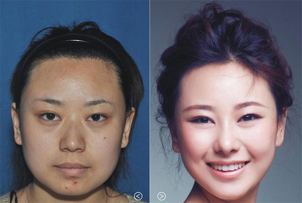 Loạt ảnh trước và sau phẫu thuật thẩm mỹ của 20 phụ nữ Trung Quốc gây sốc 5
