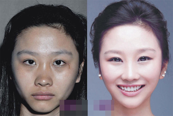Loạt ảnh trước và sau phẫu thuật thẩm mỹ của 20 phụ nữ Trung Quốc gây sốc 7