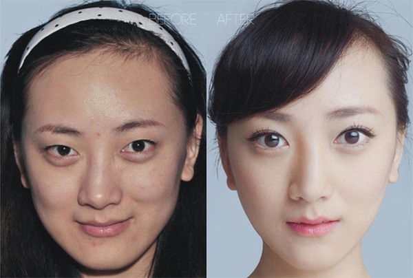 Loạt ảnh trước và sau phẫu thuật thẩm mỹ của 20 phụ nữ Trung Quốc gây sốc 8