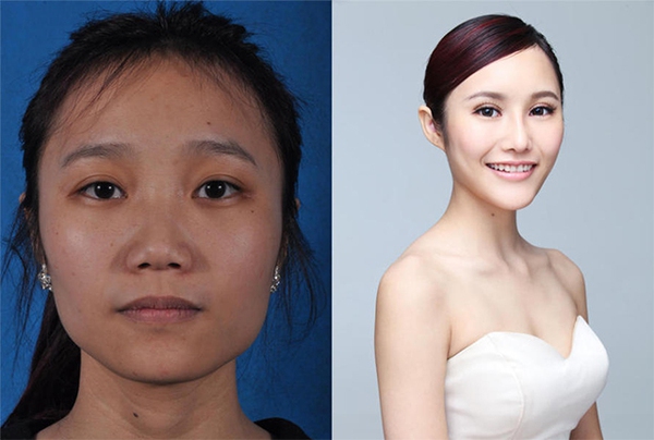Loạt ảnh trước và sau phẫu thuật thẩm mỹ của 20 phụ nữ Trung Quốc gây sốc 9