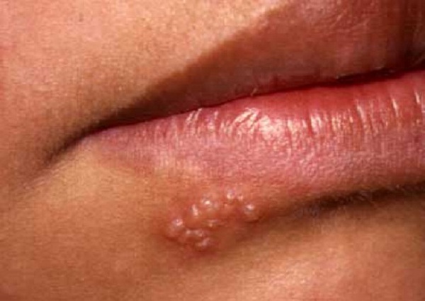 bệnh tình dục bệnh tình dục