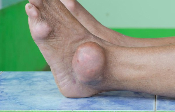 Phát hiện bệnh gút sớm từ những dấu hiệu nhỏ