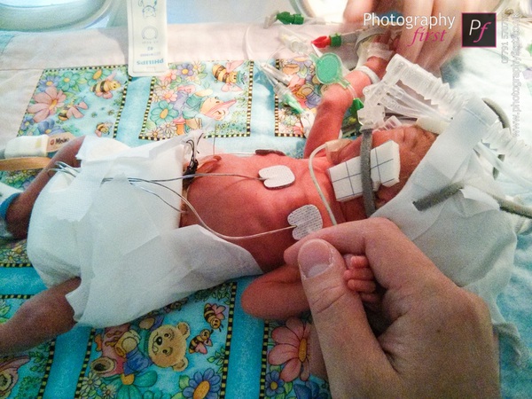 Chùm ảnh: Hành trình cảm động của em bé sinh non ở tuần thai 26  7