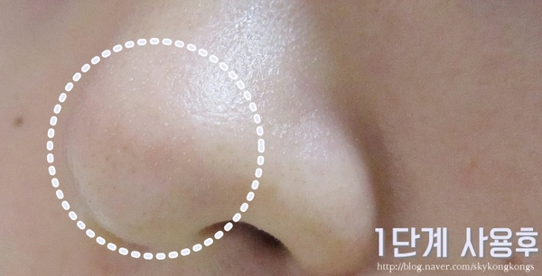 Lột mụn đầu đen Lột mụn đầu đen