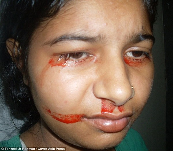 Cô bé 15 tuổi người Ấn Độ khóc và toát mồ hôi máu 1