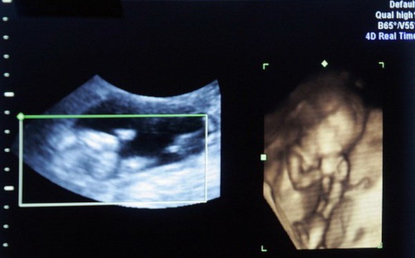 Kỳ tích phẫu thuật tim cho thai nhi trong bụng mẹ 1
