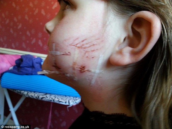 Bé gái xinh xắn mang sẹo trên mặt cả đời vì bị chó hàng xóm tấn công