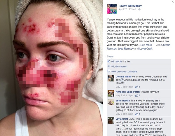 Bức ảnh cảnh báo ung thư da của bà mẹ dũng cảm hút 50.000 lượt share