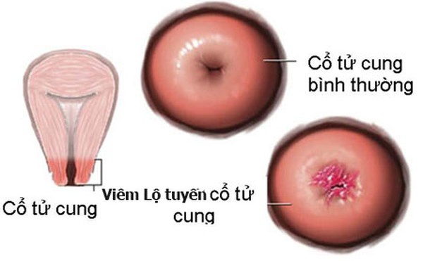 viêm lộ tuyến