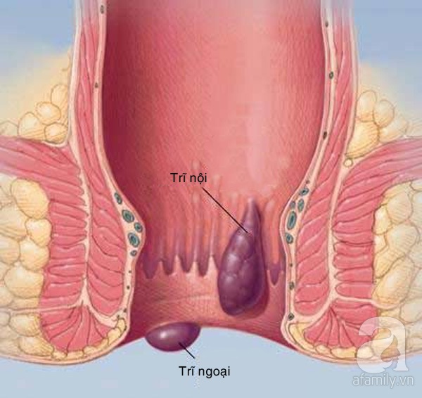 rắc rối ở hậu môn