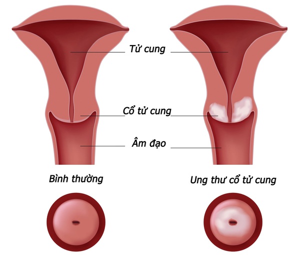 ung thư cổ tử cung