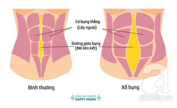 xổ bụng sau sinh