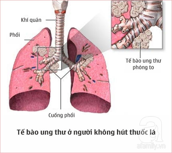 ung thư phổi