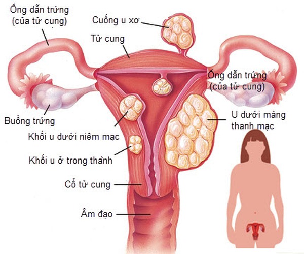 u nang cổ tử cung gây vô sinh