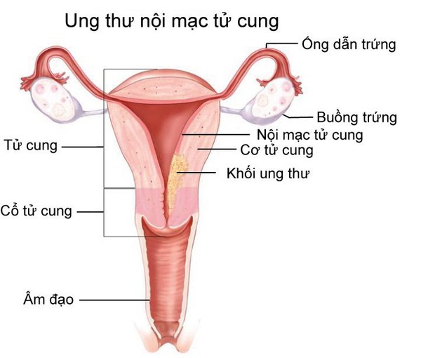 biện pháp phát hiện ung thư