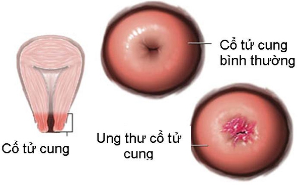 biện pháp phát hiện ung thư