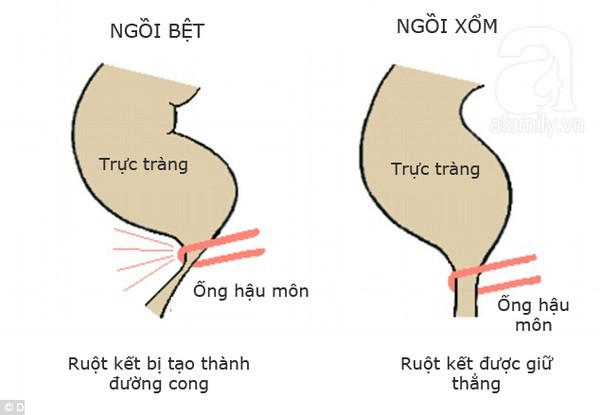 bệnh táo bón